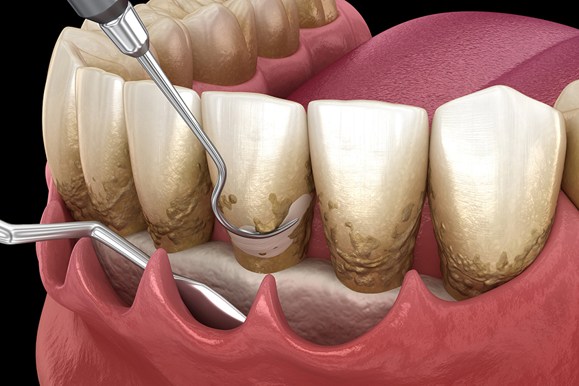市川市行徳駅前の歯周病の治療