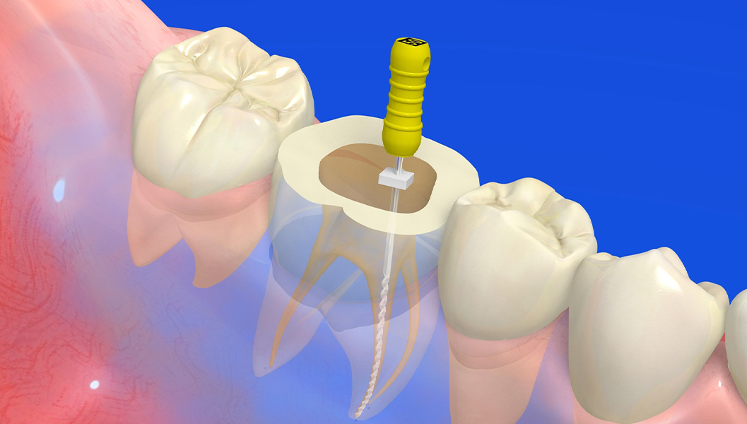 市川市行徳駅前の根管治療