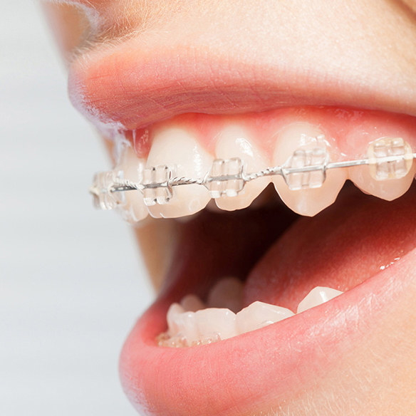 市川市行徳駅前の部分矯正