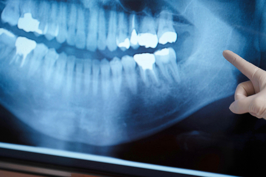 市川市行徳駅前の歯周病の治療